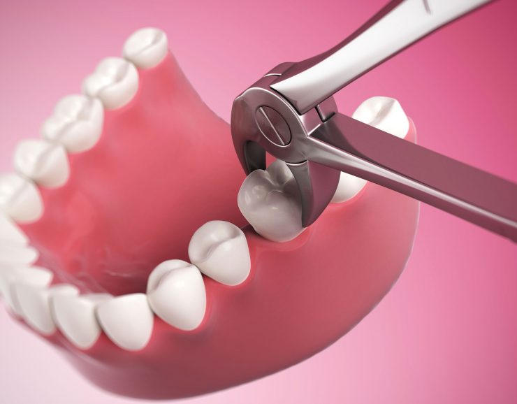 how-do-your-gums-heal-after-a-tooth-extraction-scaled